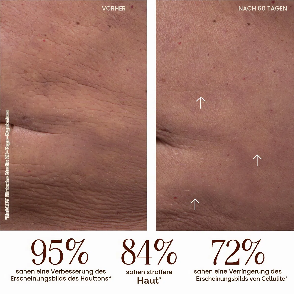 NuFACE NuBODY Toning Device - strafft Arme, Bauch, Beine und Po - Mikrostrom-Gerät zum Body Contouring - strafft die Haut und mindert Cellulite